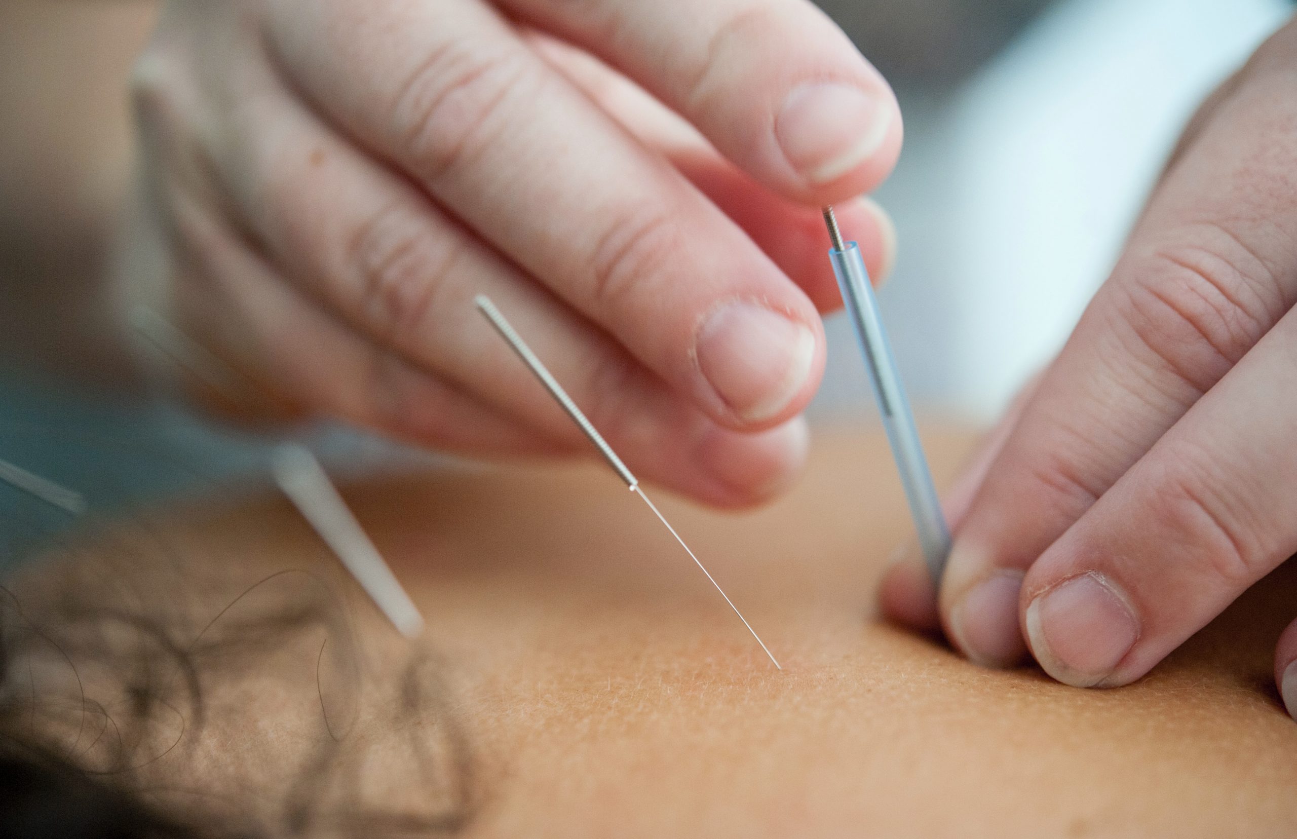 Expert A Reaction To Weight And Acupuncture Reduction